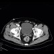 AV fistula, arteriovenous fistula in the leg: CT - Computed tomography